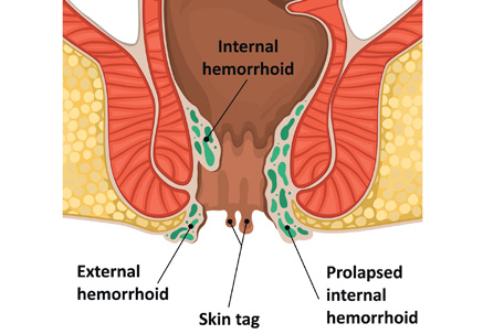 Image of Anal Skin Tags