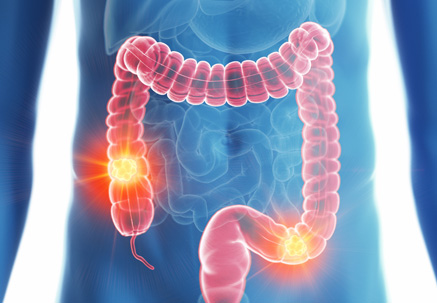 Image of Colorectal Cancer
