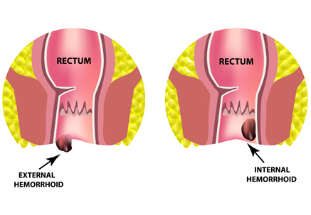 Image of external and internal hemorrhoids